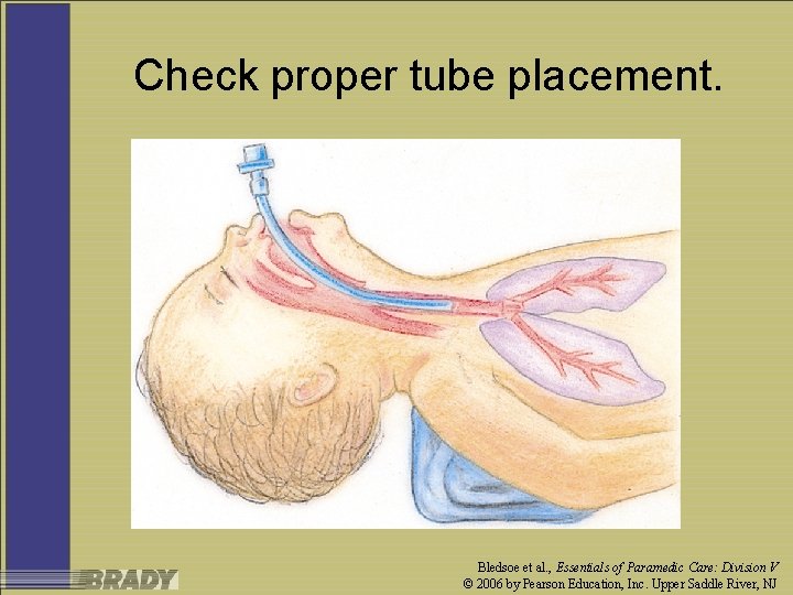 Check proper tube placement. Bledsoe et al. , Essentials of Paramedic Care: Division V