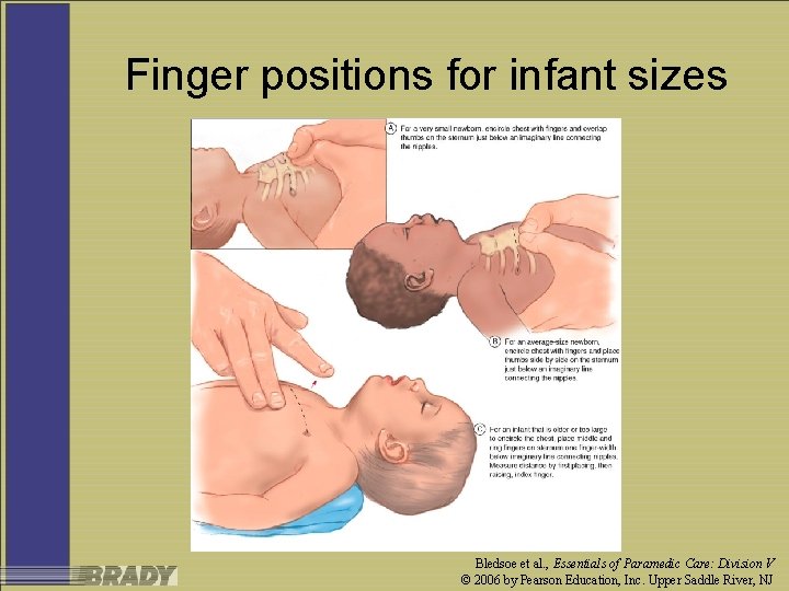 Finger positions for infant sizes Bledsoe et al. , Essentials of Paramedic Care: Division