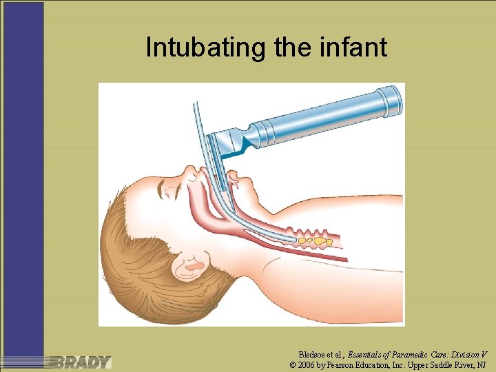 Intubating the infant Bledsoe et al. , Essentials of Paramedic Care: Division V ©