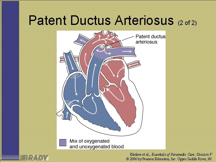 Patent Ductus Arteriosus (2 of 2) Bledsoe et al. , Essentials of Paramedic Care: