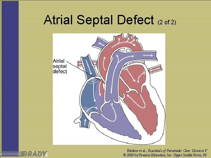 Atrial Septal Defect (2 of 2) Bledsoe et al. , Essentials of Paramedic Care: