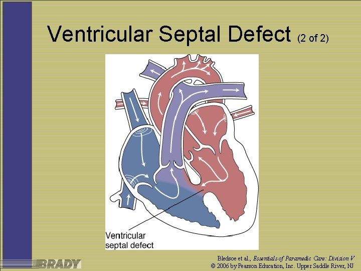 Ventricular Septal Defect (2 of 2) Bledsoe et al. , Essentials of Paramedic Care: