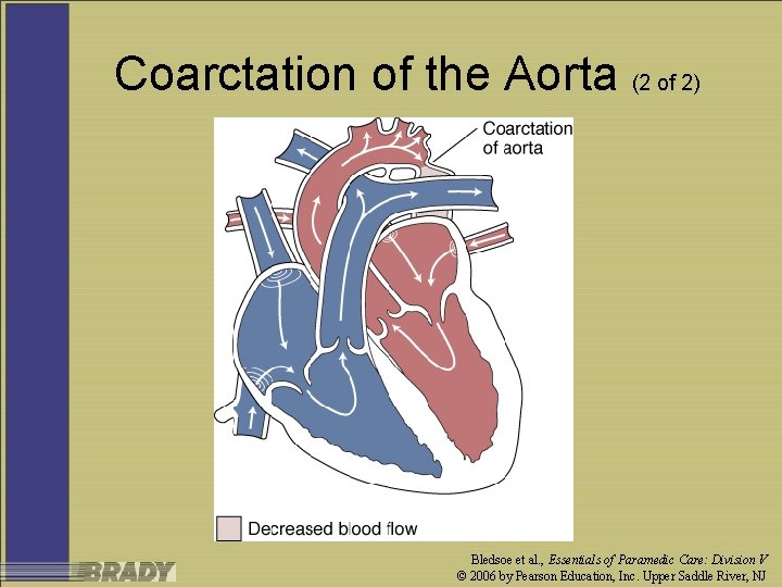 Coarctation of the Aorta (2 of 2) Bledsoe et al. , Essentials of Paramedic