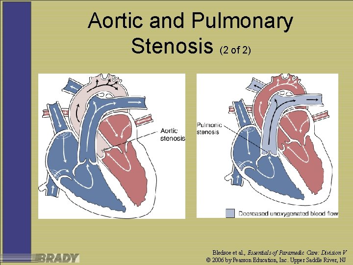 Aortic and Pulmonary Stenosis (2 of 2) Bledsoe et al. , Essentials of Paramedic