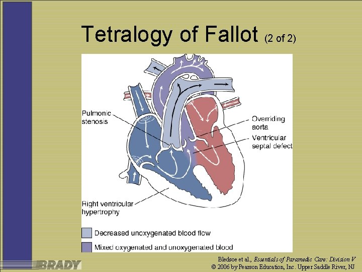 Tetralogy of Fallot (2 of 2) Bledsoe et al. , Essentials of Paramedic Care: