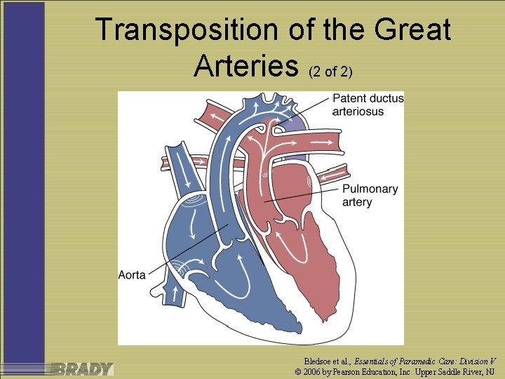 Transposition of the Great Arteries (2 of 2) Bledsoe et al. , Essentials of