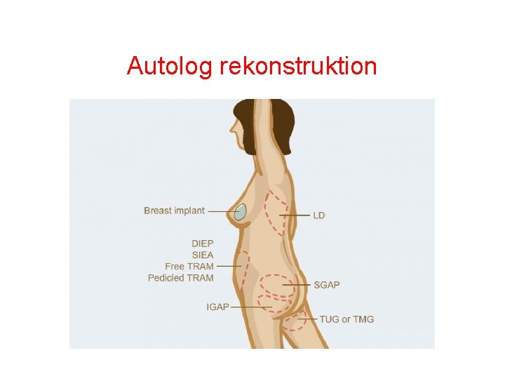 Autolog rekonstruktion 