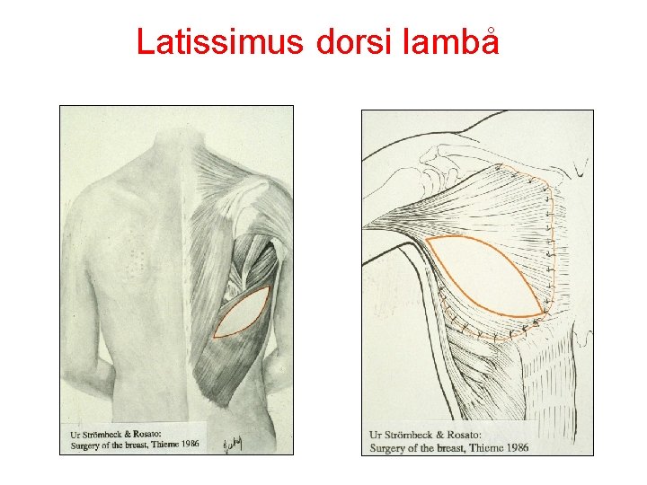 Latissimus dorsi lambå 