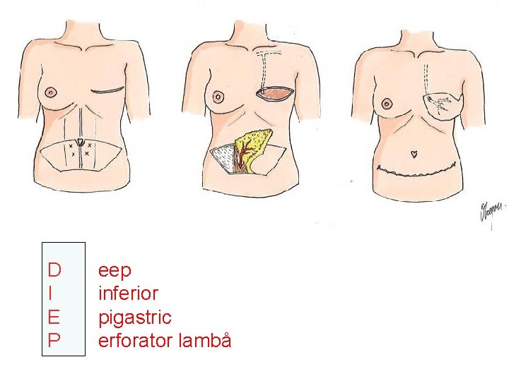 D I E P eep inferior pigastric erforator lambå 