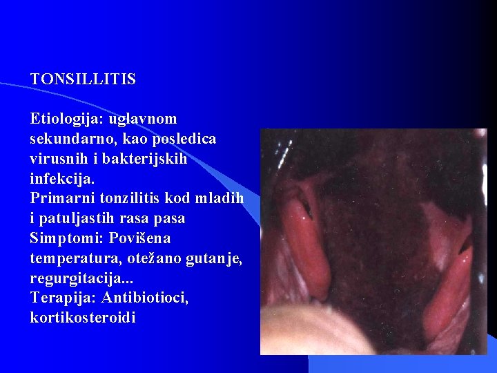 TONSILLITIS Etiologija: uglavnom sekundarno, kao posledica virusnih i bakterijskih infekcija. Primarni tonzilitis kod mladih