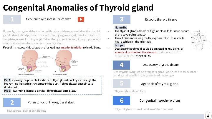 Congenital Anomalies of Thyroid gland 1 3 Cervical thyroglossal duct cyst Normally, thyroglossal duct