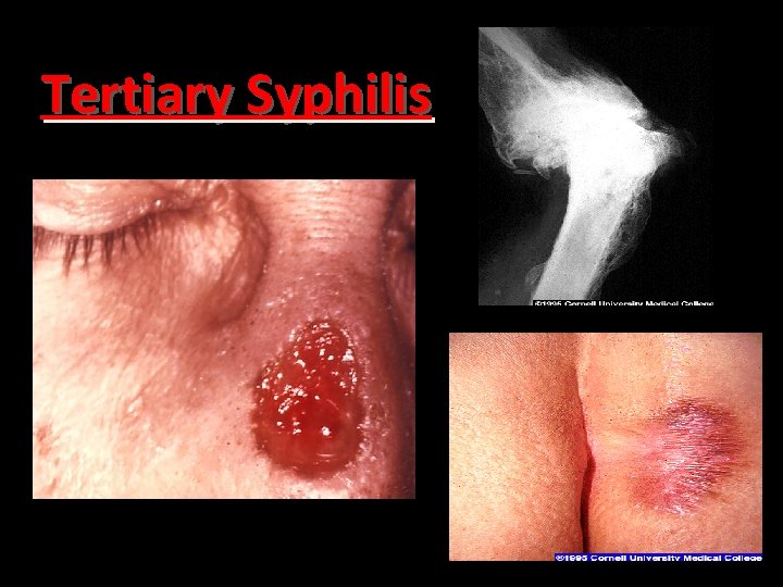 Tertiary Syphilis 