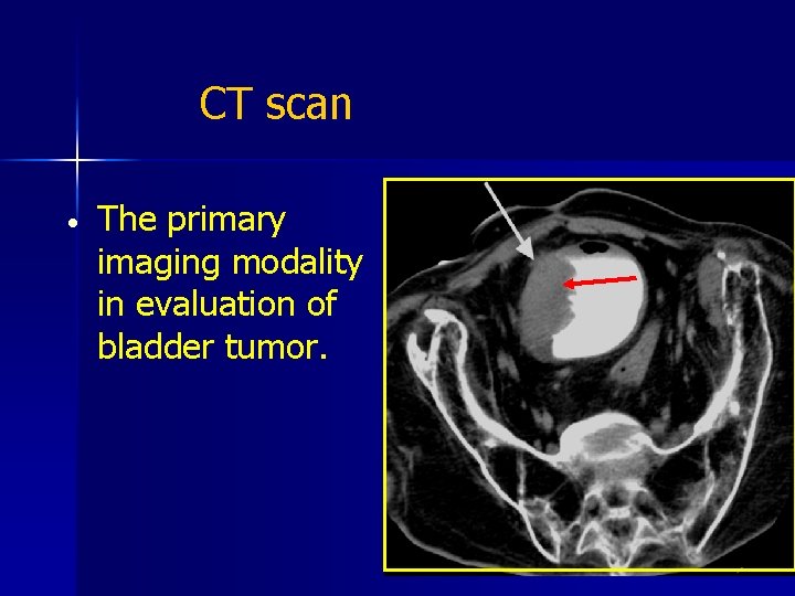 CT scan The primary imaging modality in evaluation of bladder tumor. 