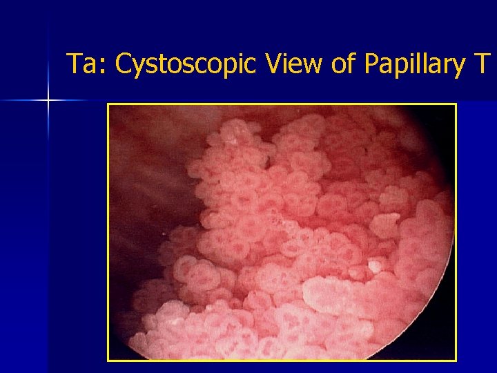 Ta: Cystoscopic View of Papillary T 