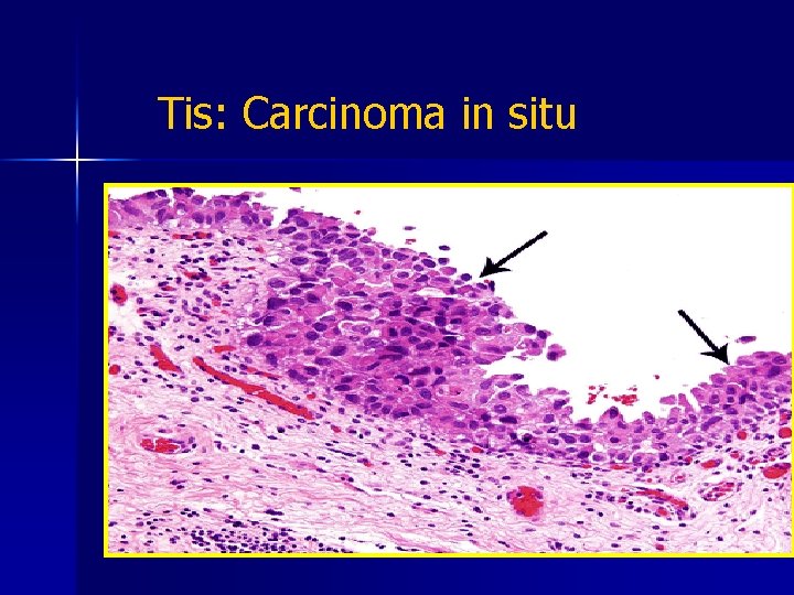 Tis: Carcinoma in situ 