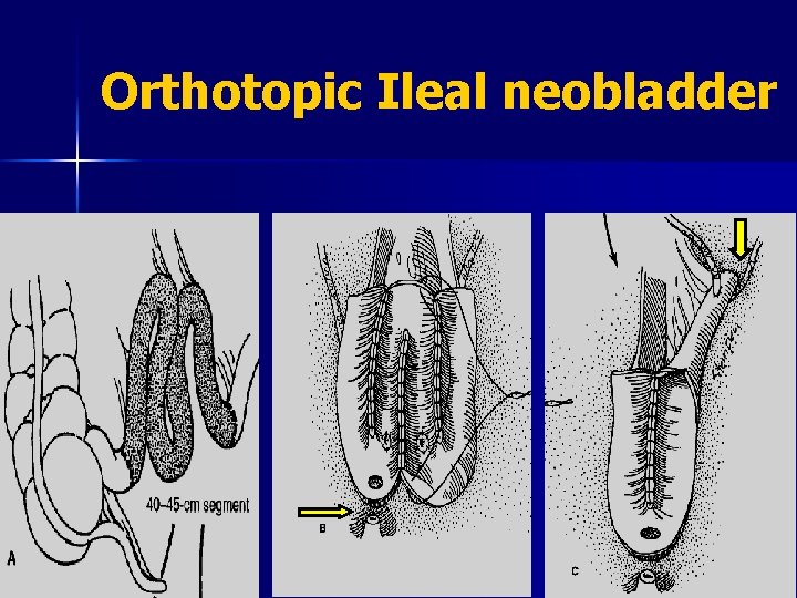 Orthotopic Ileal neobladder 