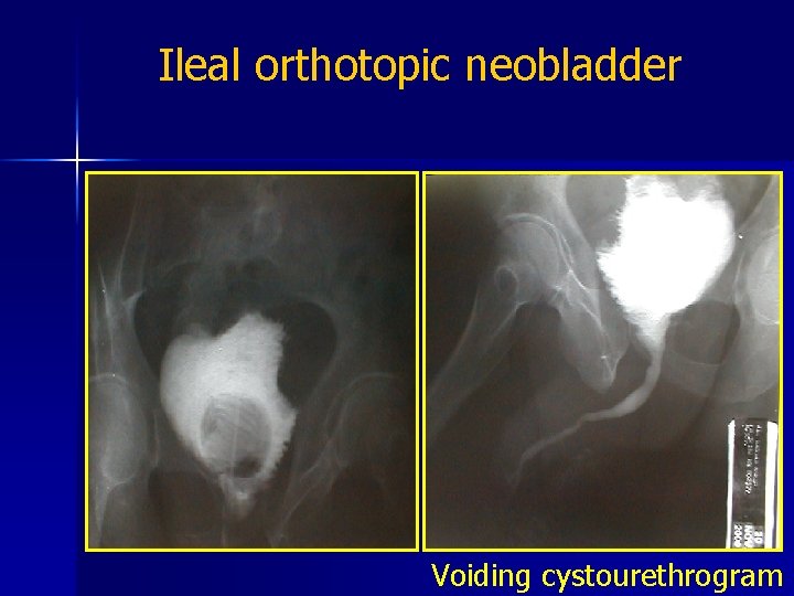 Ileal orthotopic neobladder Voiding cystourethrogram 