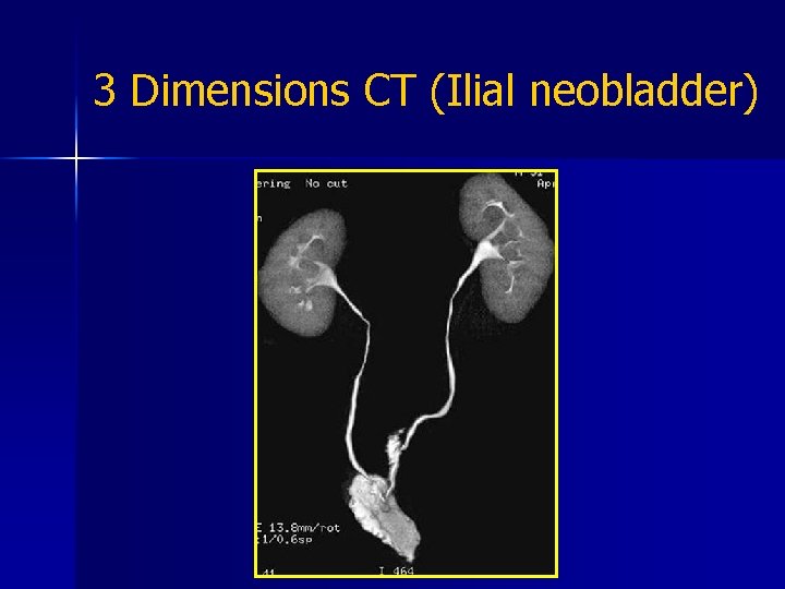 3 Dimensions CT (Ilial neobladder) 