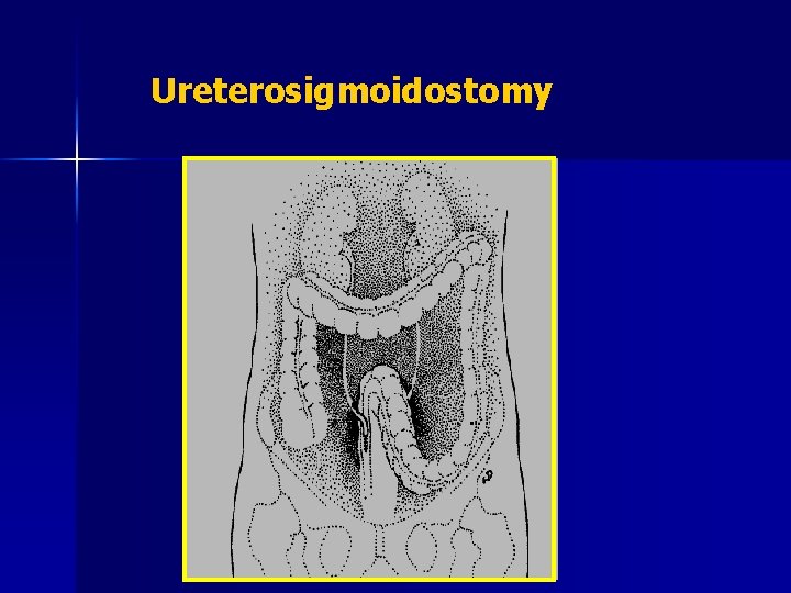 Ureterosigmoidostomy 