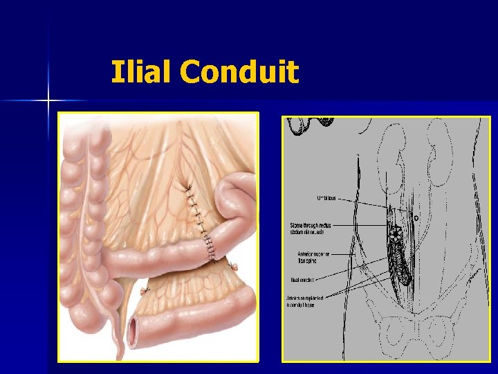 Ilial Conduit 