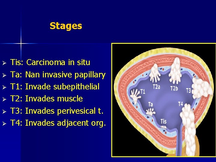 Stages Ø Ø Ø Tis: Carcinoma in situ Ta: Nan invasive papillary T 1: