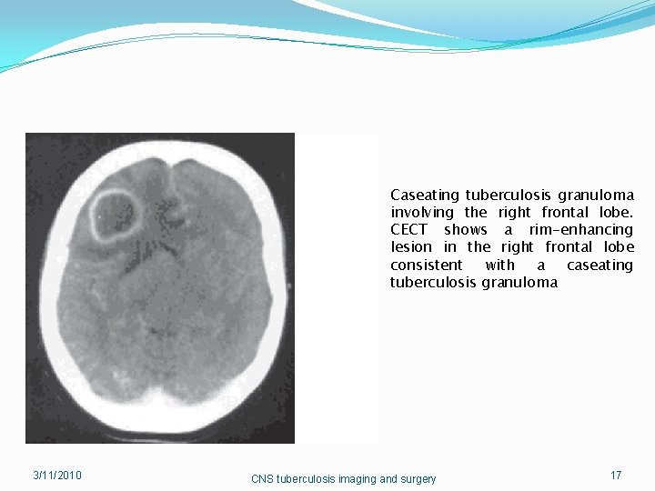Caseating tuberculosis granuloma involving the right frontal lobe. CECT shows a rim-enhancing lesion in