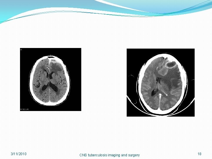 3/11/2010 CNS tuberculosis imaging and surgery 18 