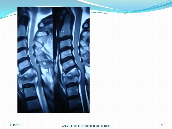 3/11/2010 CNS tuberculosis imaging and surgery 22 