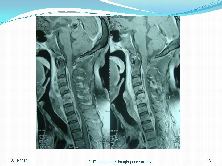 3/11/2010 CNS tuberculosis imaging and surgery 23 