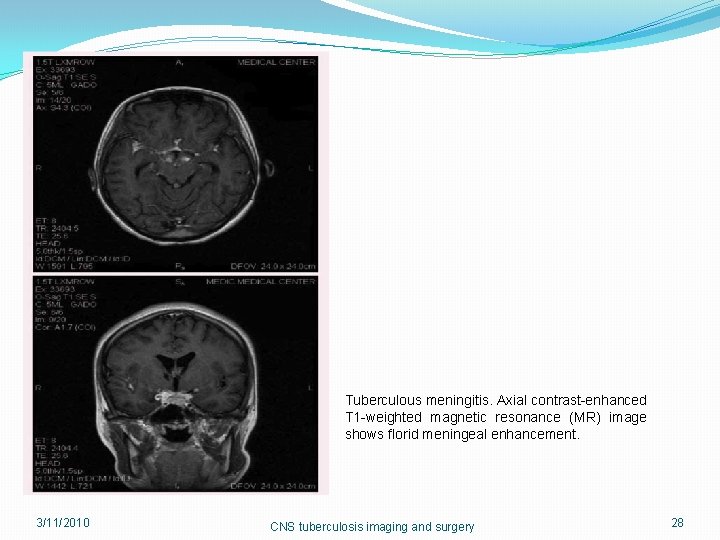 Tuberculous meningitis. Axial contrast-enhanced T 1 -weighted magnetic resonance (MR) image shows florid meningeal