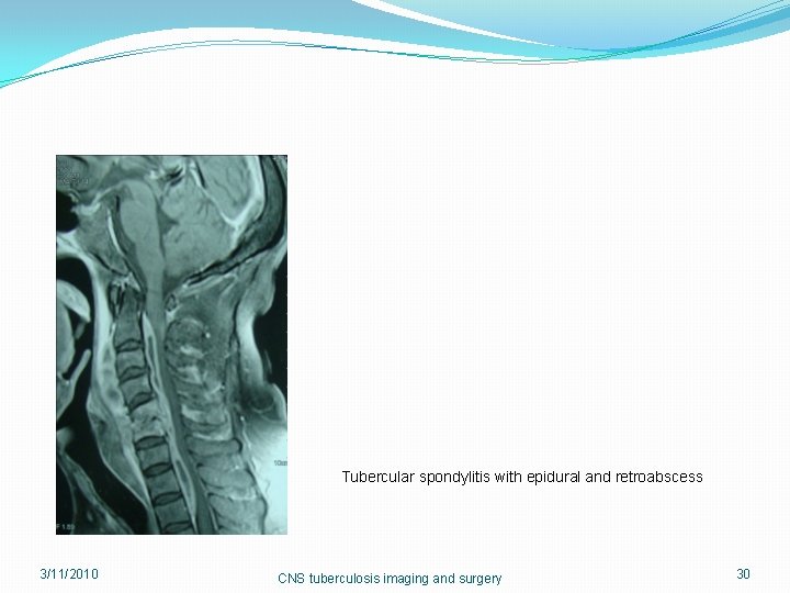 Tubercular spondylitis with epidural and retroabscess 3/11/2010 CNS tuberculosis imaging and surgery 30 