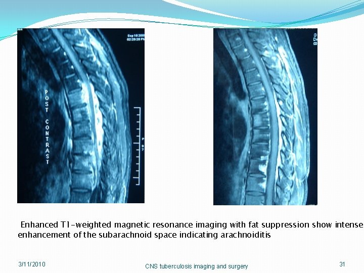 Enhanced T 1 -weighted magnetic resonance imaging with fat suppression show intense enhancement of