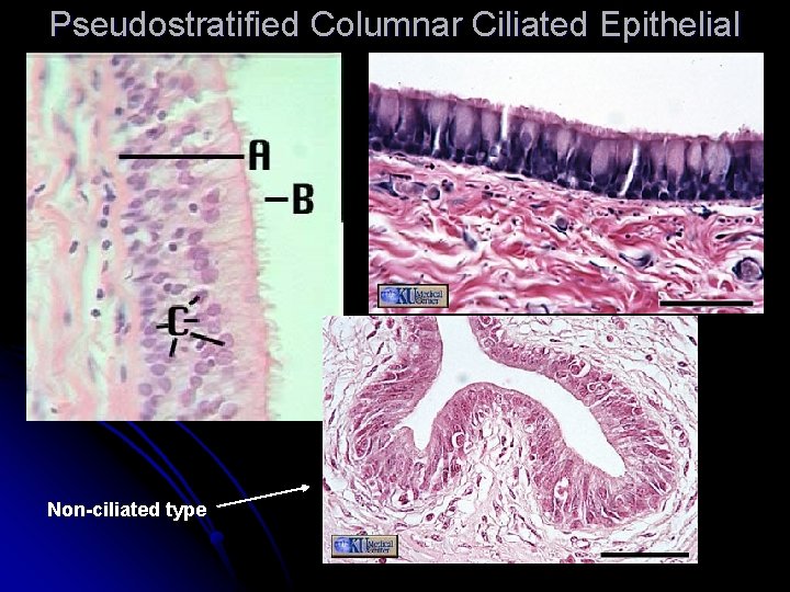 Pseudostratified Columnar Ciliated Epithelial Non-ciliated type 