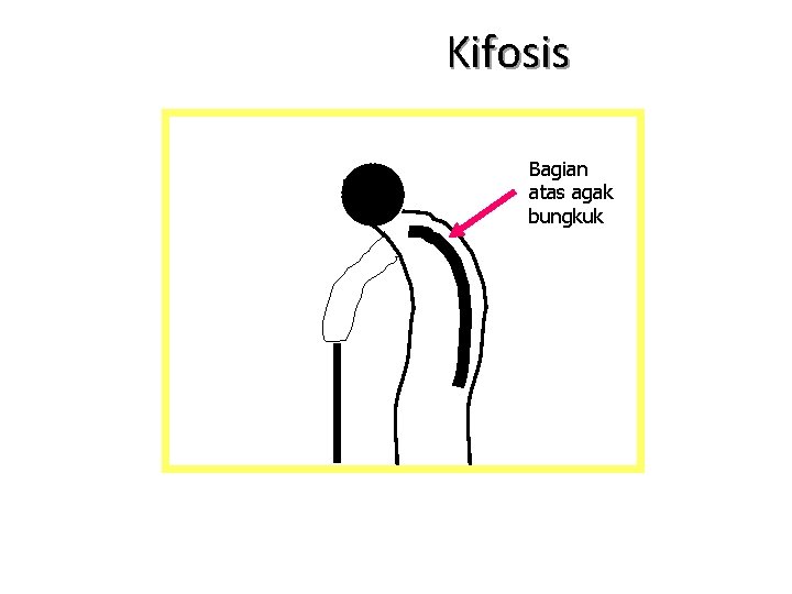 Kifosis ? Bagian atas agak bungkuk 