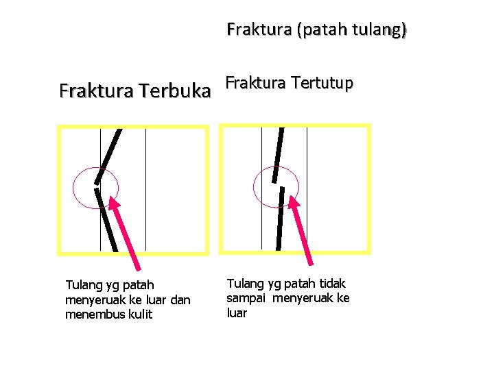 Fraktura (patah tulang) Fraktura Terbuka Tulang yg patah menyeruak ke luar dan menembus kulit