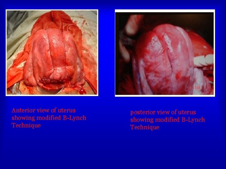 Anterior view of uterus showing modified B-Lynch Technique posterior view of uterus showing modified