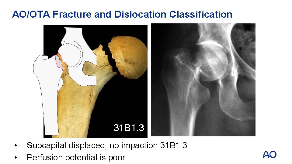 AO/OTA Fracture and Dislocation Classification 31 B 1. 3 • • Subcapital displaced, no