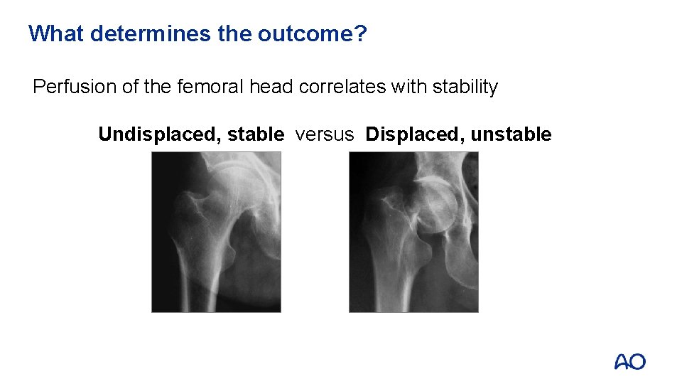 What determines the outcome? Perfusion of the femoral head correlates with stability Undisplaced, stable