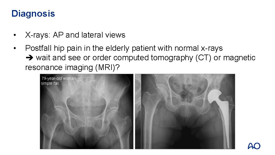 Diagnosis • X-rays: AP and lateral views • Postfall hip pain in the elderly