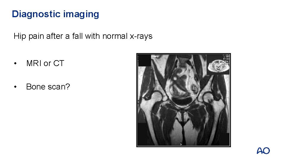 Diagnostic imaging Hip pain after a fall with normal x-rays • MRI or CT