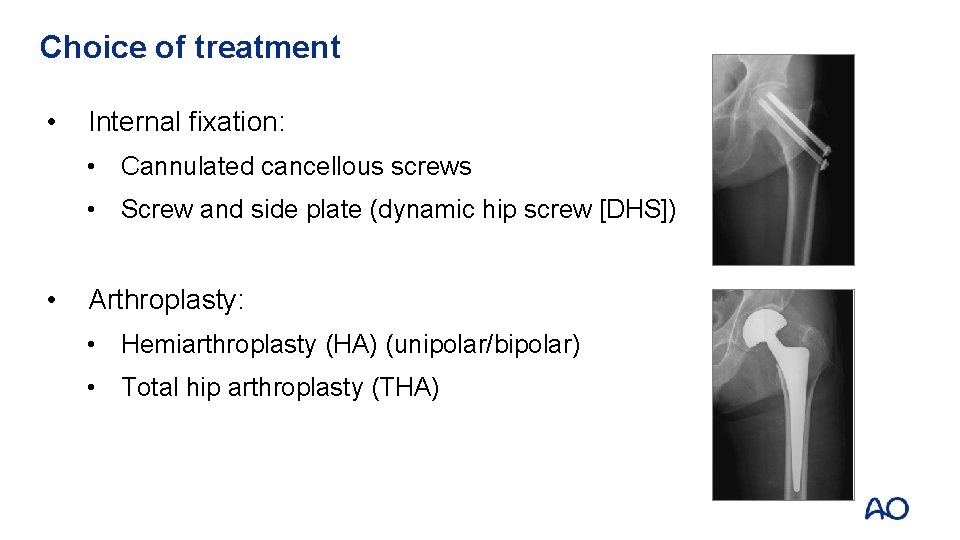 Choice of treatment • Internal fixation: • Cannulated cancellous screws • Screw and side