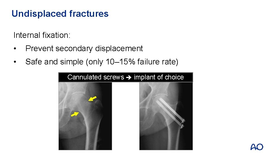 Undisplaced fractures Internal fixation: • Prevent secondary displacement • Safe and simple (only 10–