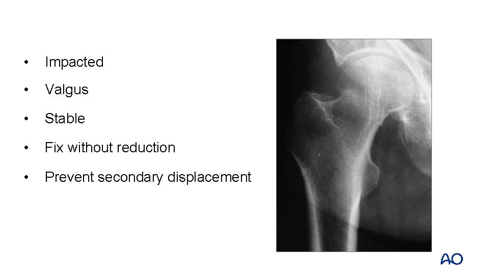  • Impacted • Valgus • Stable • Fix without reduction • Prevent secondary
