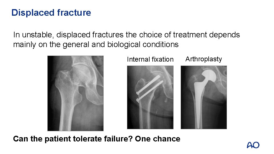 Displaced fracture In unstable, displaced fractures the choice of treatment depends mainly on the