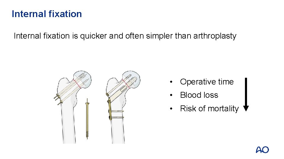 Internal fixation is quicker and often simpler than arthroplasty • Operative time • Blood