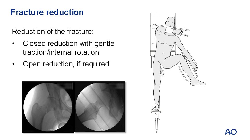 Fracture reduction Reduction of the fracture: • Closed reduction with gentle traction/internal rotation •