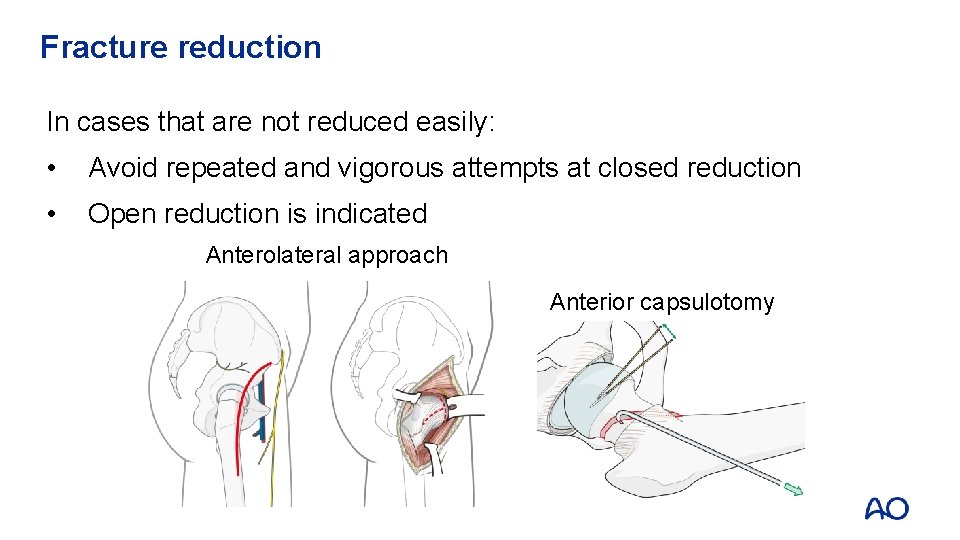 Fracture reduction In cases that are not reduced easily: • Avoid repeated and vigorous