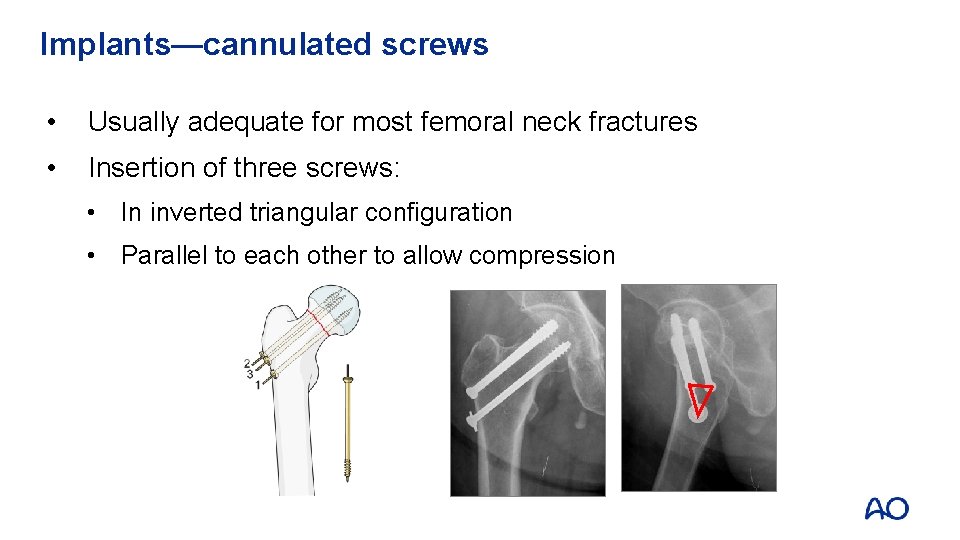 Implants—cannulated screws • Usually adequate for most femoral neck fractures • Insertion of three