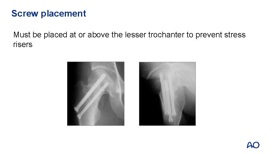 Screw placement Must be placed at or above the lesser trochanter to prevent stress