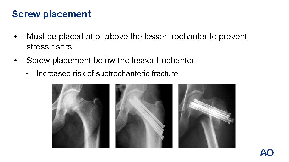 Screw placement • Must be placed at or above the lesser trochanter to prevent